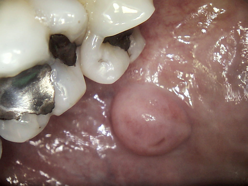 CS 1500 klinisk billede — spytkirtelgang